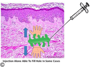 Stem Cells for Acne Scar Treartment