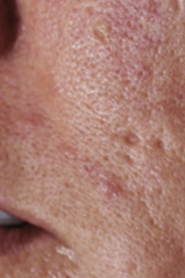 ice pick acne scars