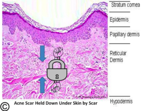 subscision and fat grafting for acne scarring rolling acne scars