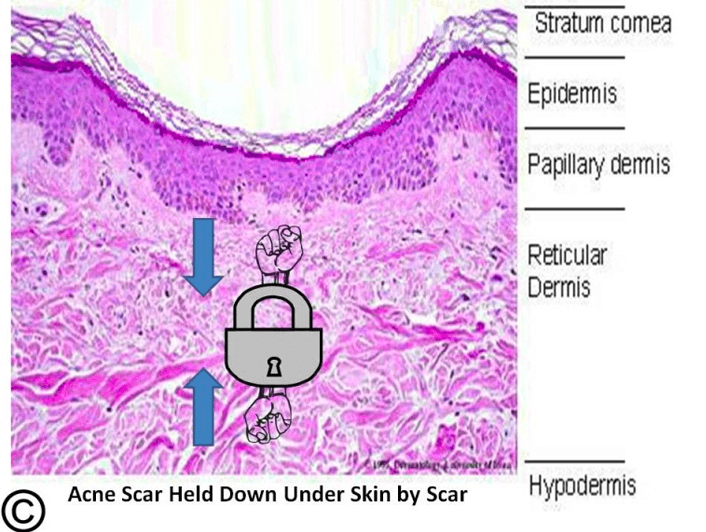 Scar beneath acne scar