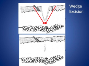 TREATMENTS_Excision