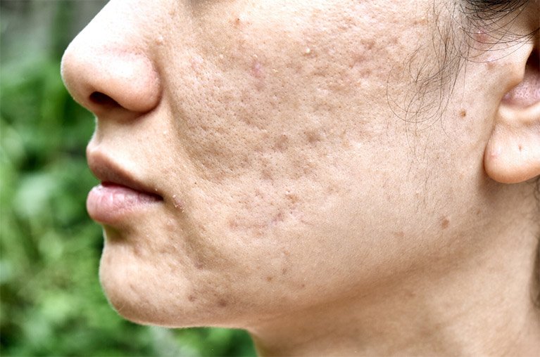Severe acne scar fat loss of the face