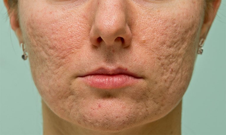 Combination of scar types in severe acne scar