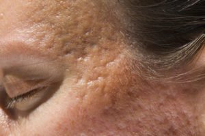 Temple acne scar