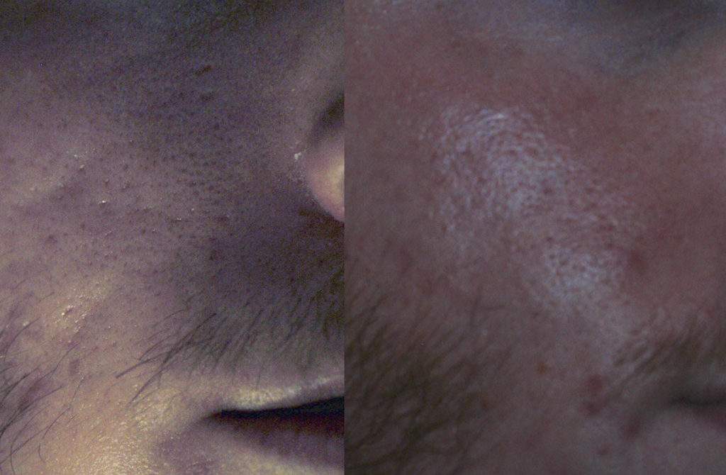 Cheek rolling scar before and after subcision and fat grafting