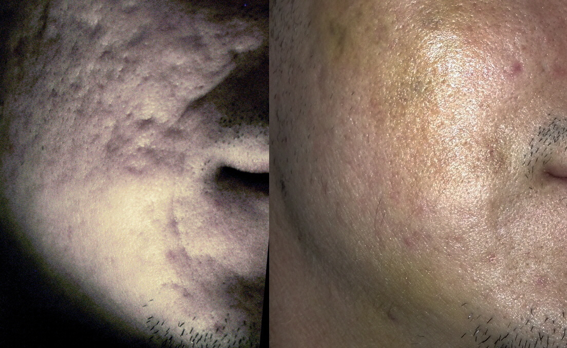 Before and after Severe Rolling Acne Scar Subcision and Fat Grafted