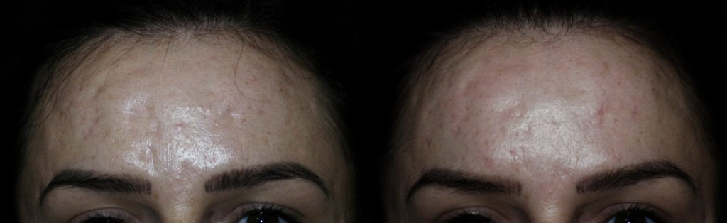 Severe Forehead Acne Scar Before and After subcision and fat grafting