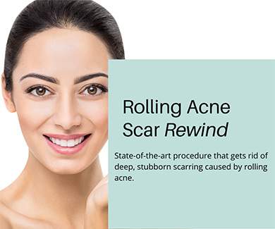 Rolling acne scar rewind procedure scarring