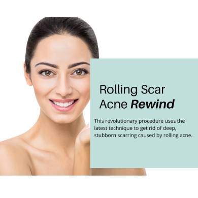 the deep acne scars (Rewind)