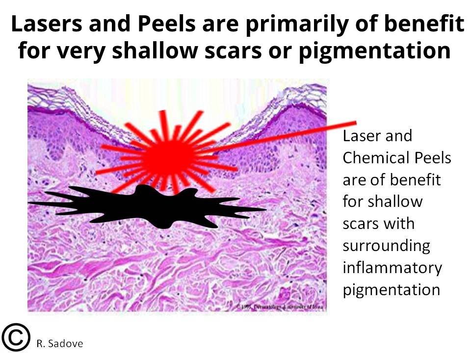 lasers and chemical peels