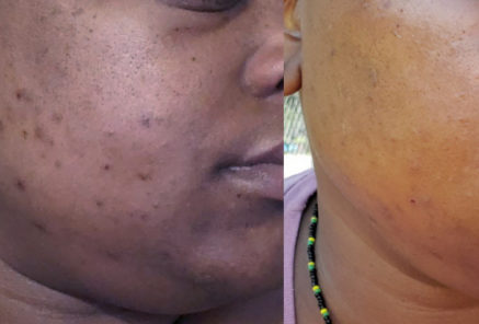 Correction of PIH after Acne in dark skin