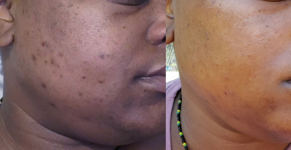 Correction of PIH after Acne in dark skin