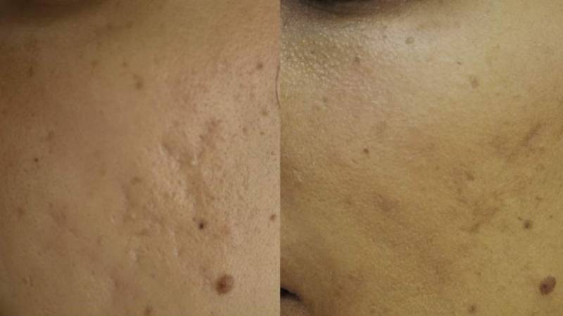 Acne Scar Excision Before And After