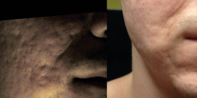 Correction of cheek acne scar