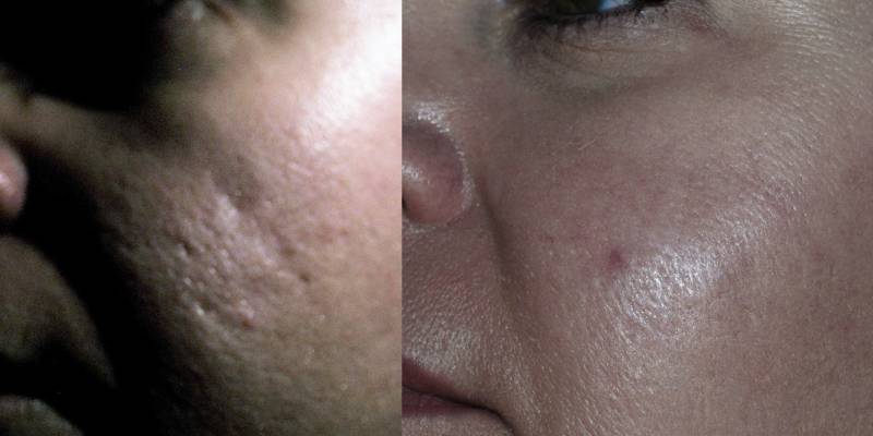 Acne Scar Subcision With Fat Graft Before And After