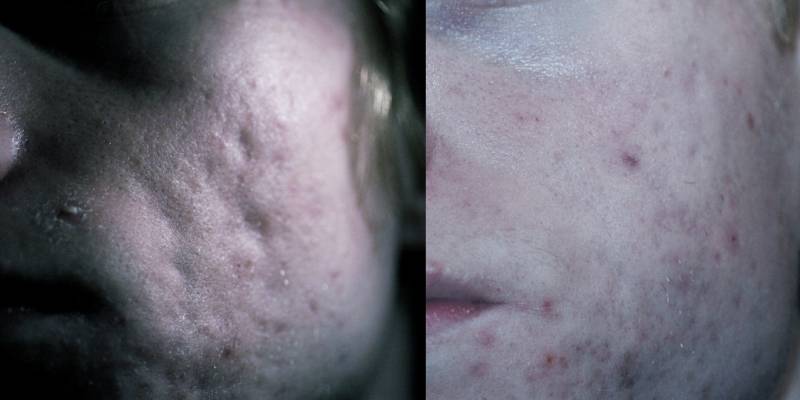 Rolling Acne Scar Subcision with Fat graft Before and After