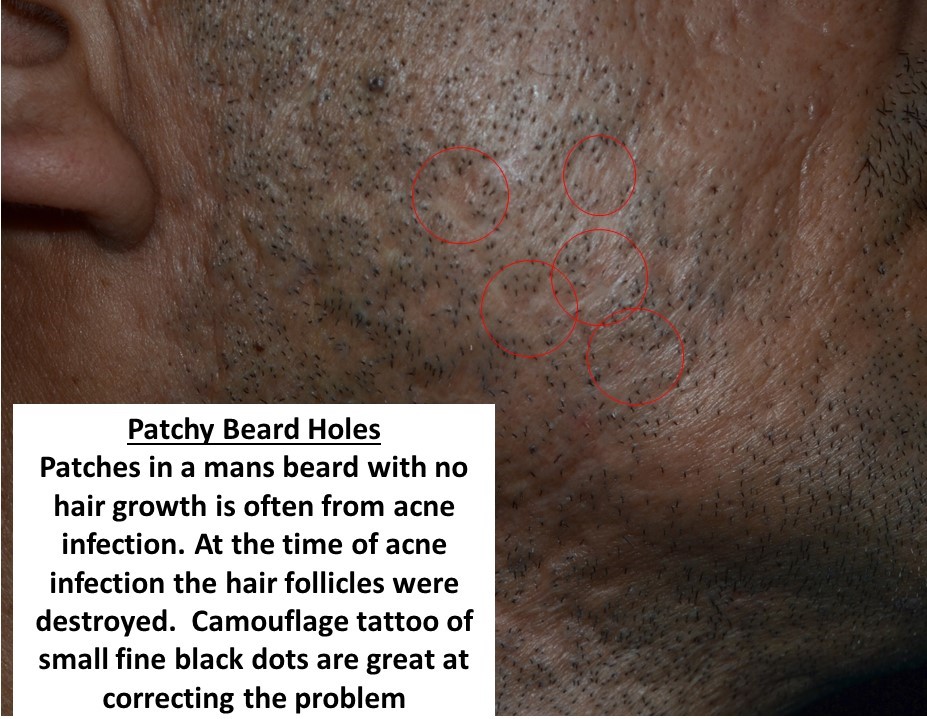 patchy-beard after acne scar are treated with camouflage tattoo