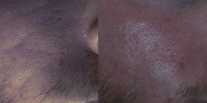 Rewind Acne Scar of the cheek before and after sub cision and fat grafting