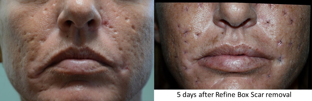 Ice Pick Excision Acne Scars Excision Treatment Florida Ice Pick Excision Acne Scars Excision Treatment Florida