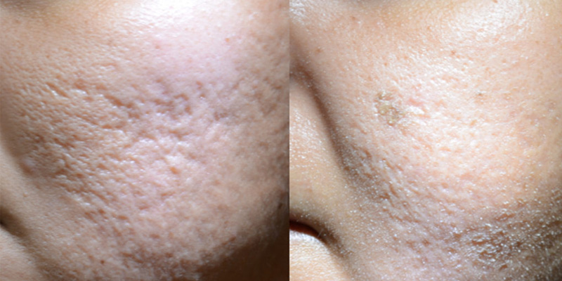 Rolling Scar treated with Rewind technique before and after