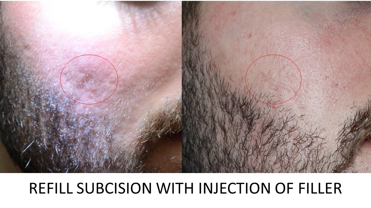 Refill Subcision with Filler