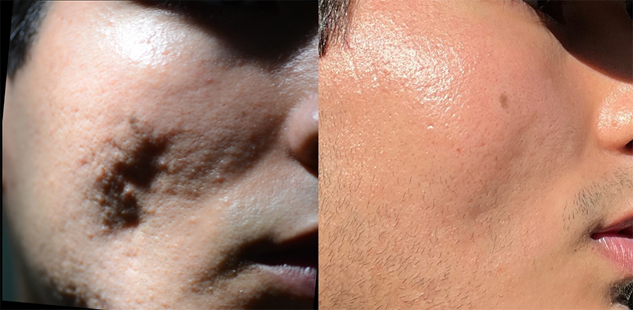 Rewind Acne Scar of the cheek before and after sub cision and fat grafting