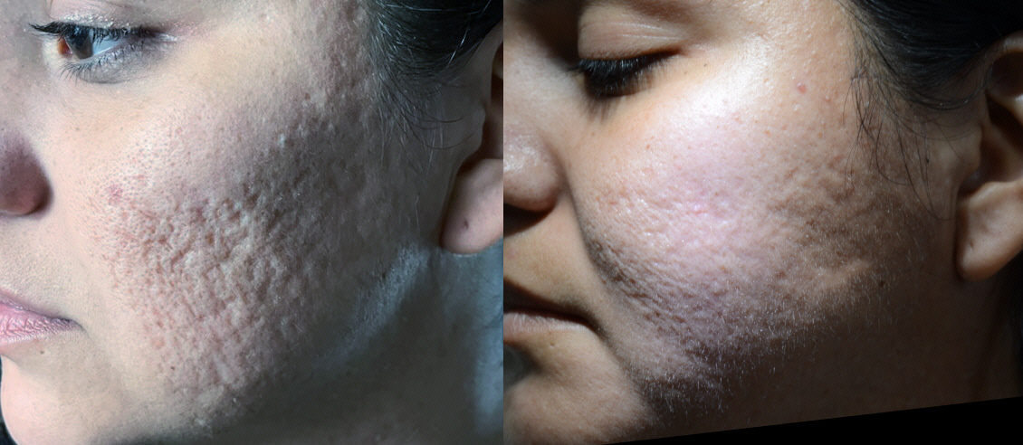 Acne Scar Subcision with Fat graft Before and After