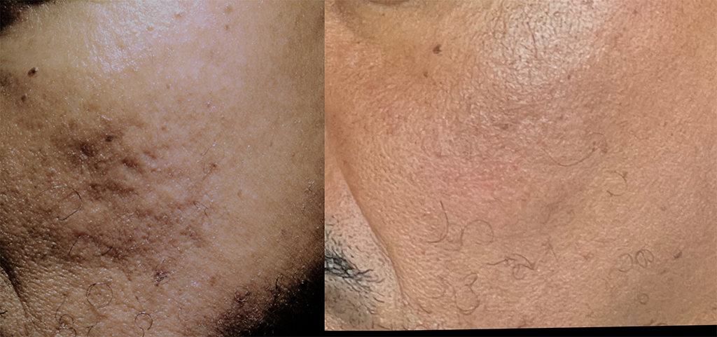 Rewind Subscision with autofat grafting for rolling scars
