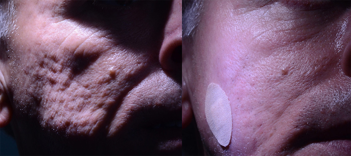 Rewind sub-cision and fat graft to the right face for acne scar