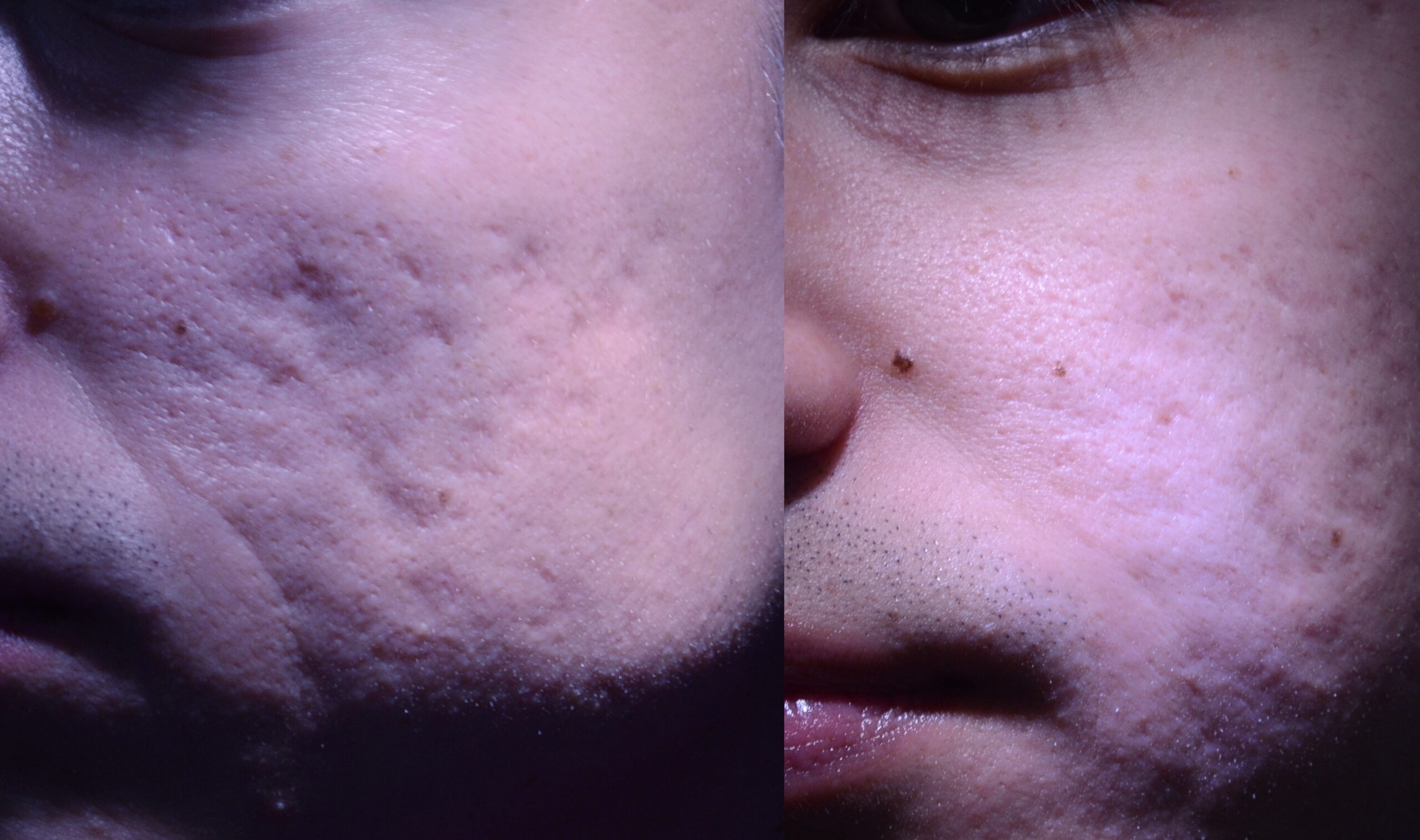 Rewind acne scar treatment