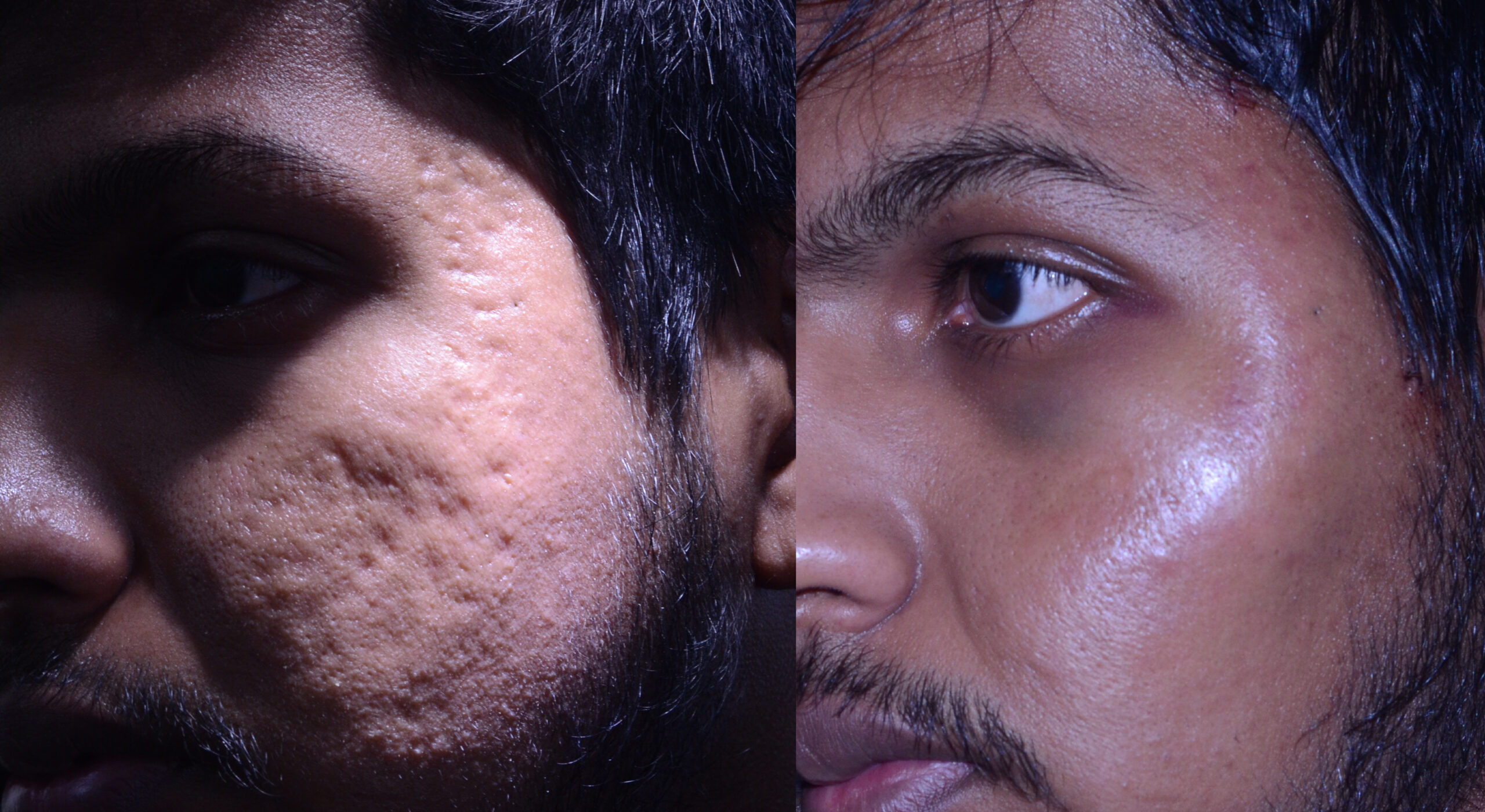Acne scar treatment of temples and cheeks