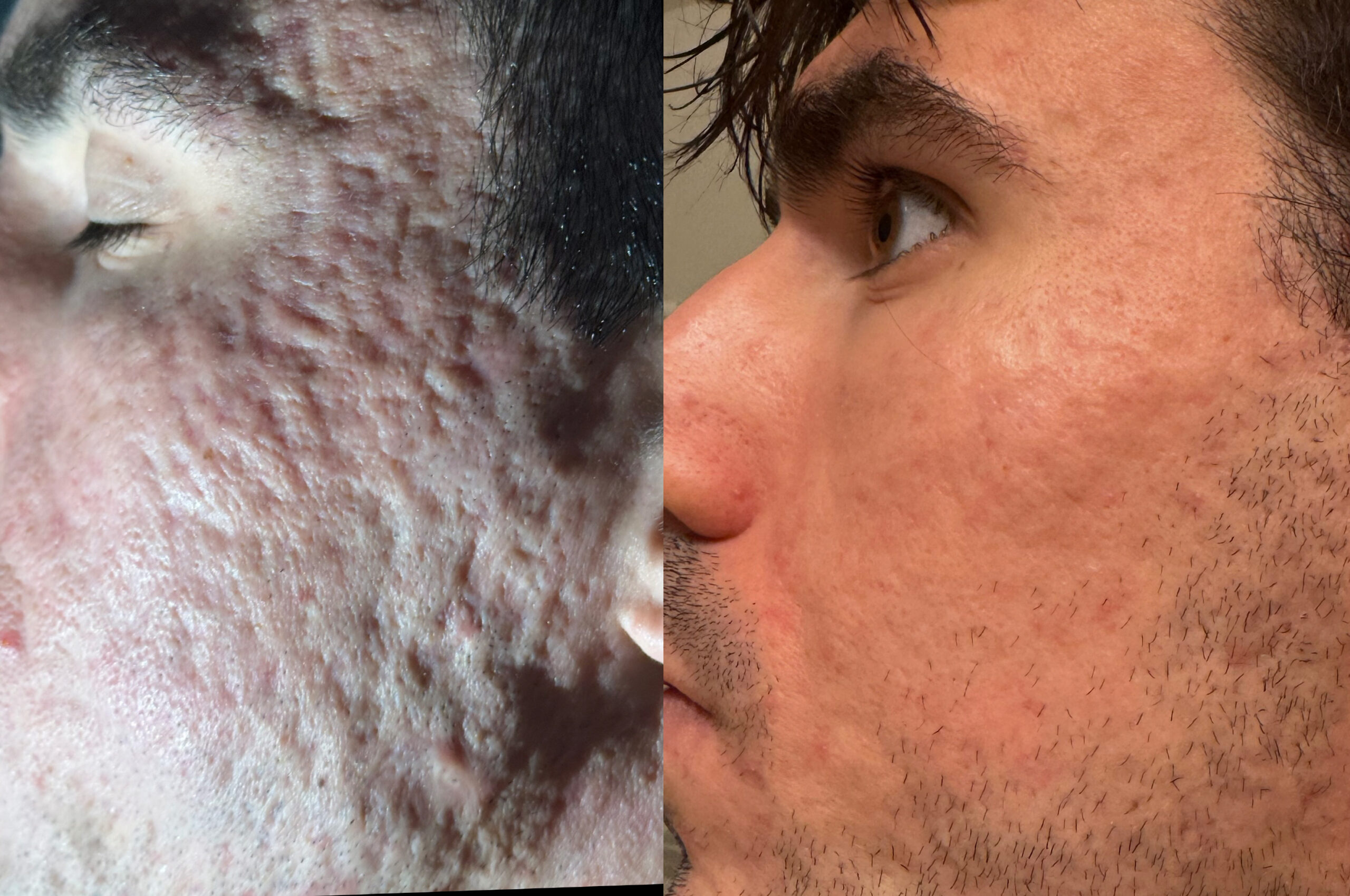 Rewind Acne Scar Subcision and Fat Graft