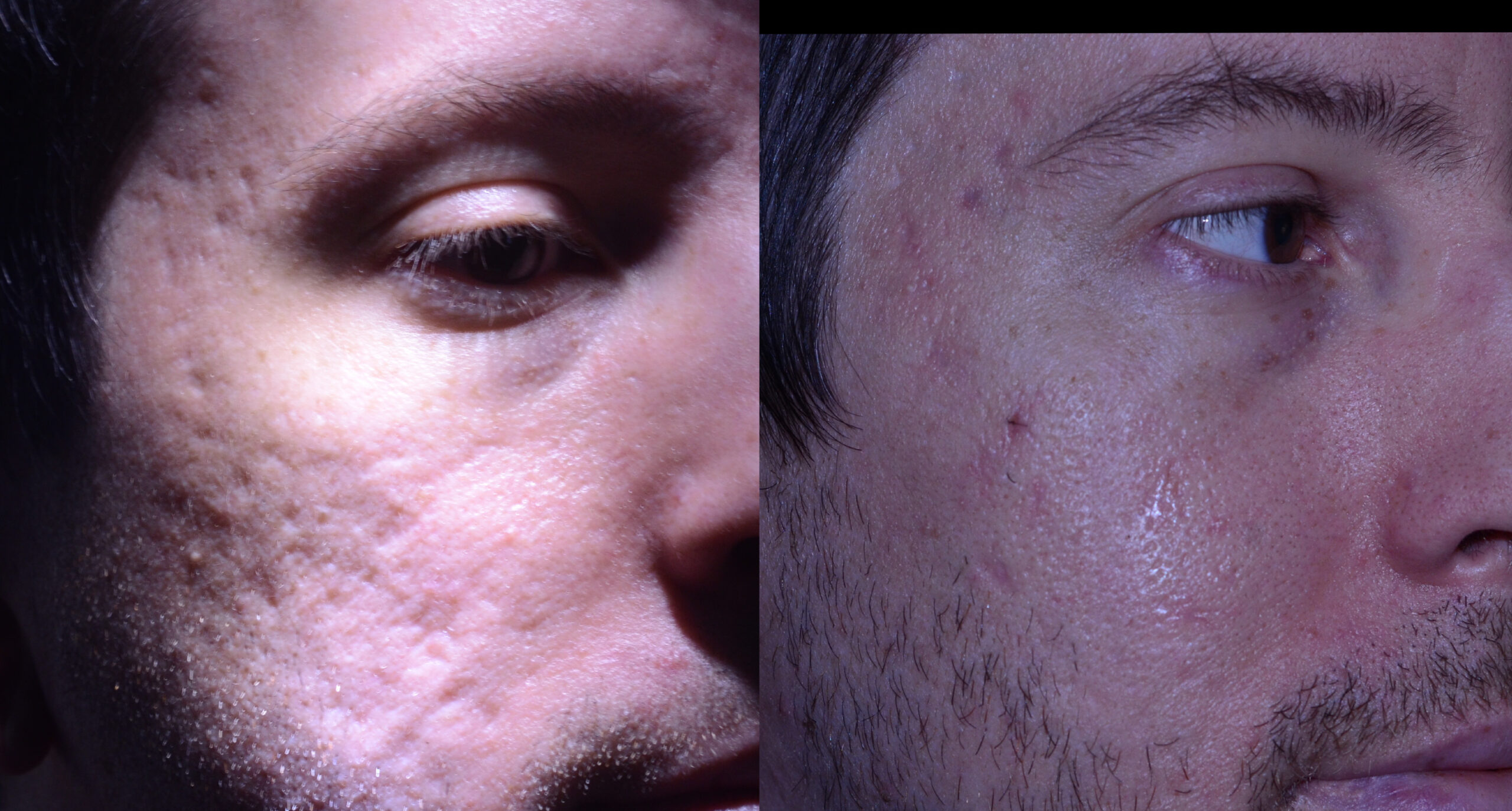 Rewind Subcision and Fat Graft with some excisions