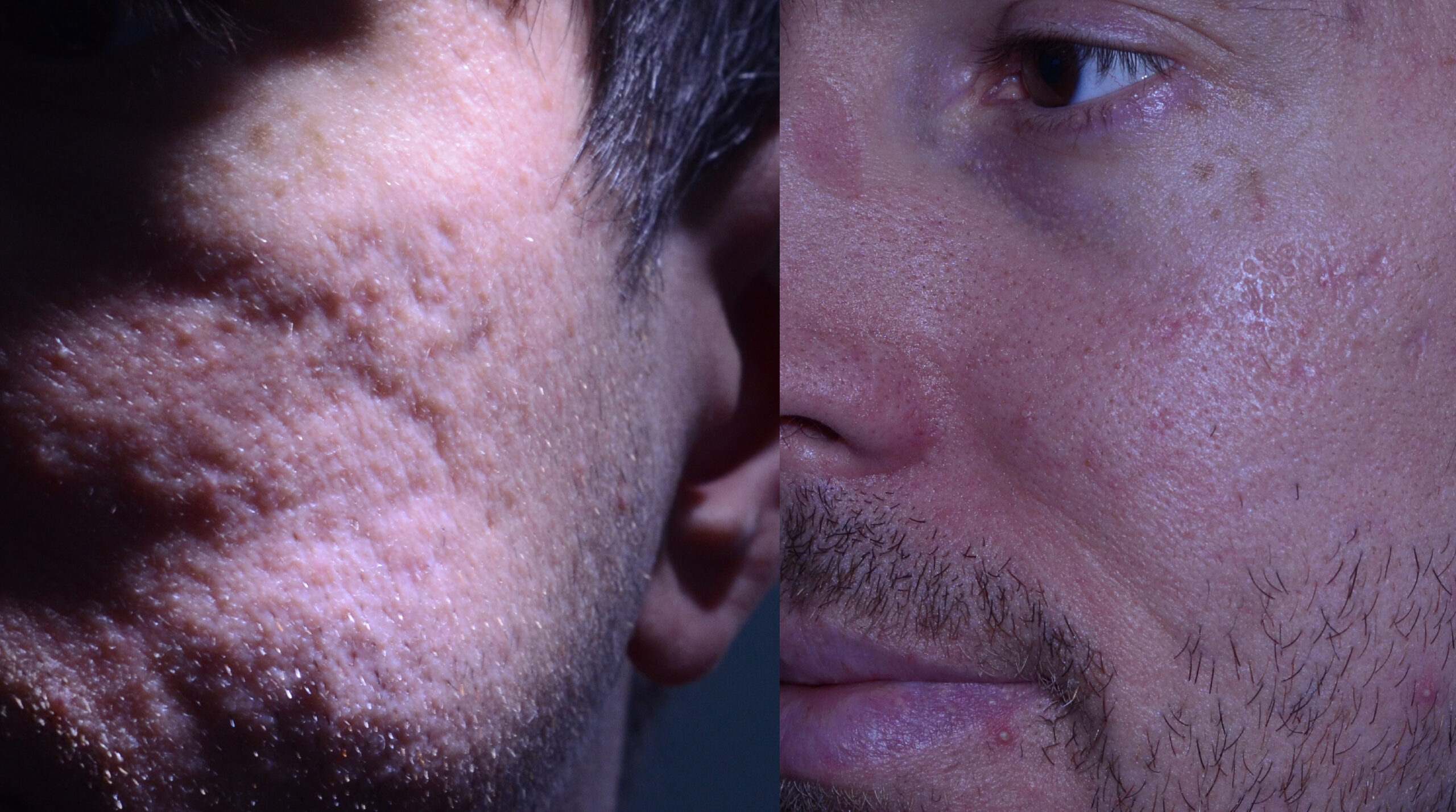 Before and After Subcision and Fat Graft