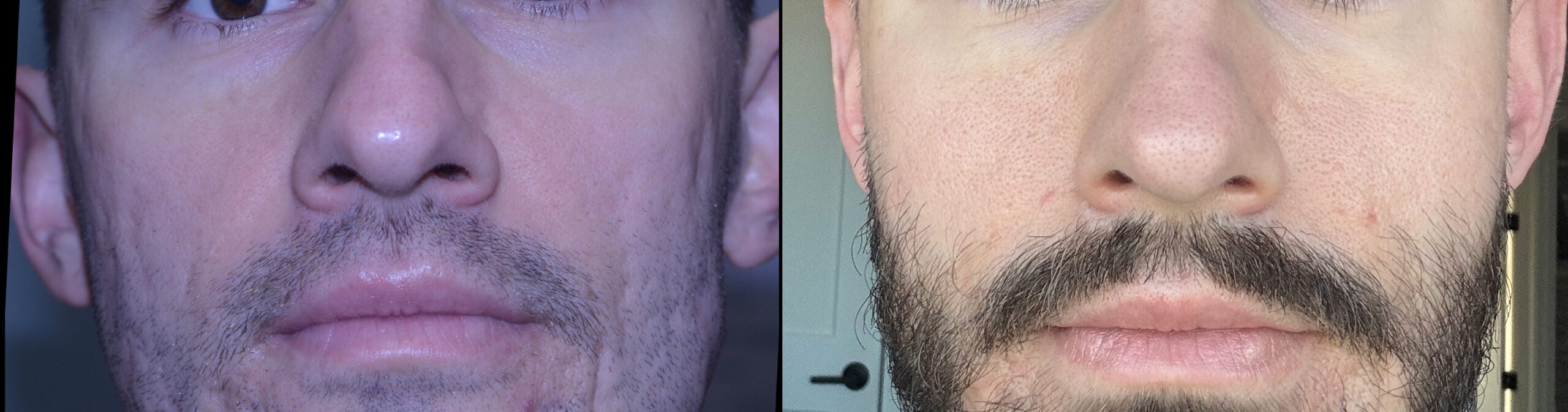 Subcision and Fat Grafting before and after