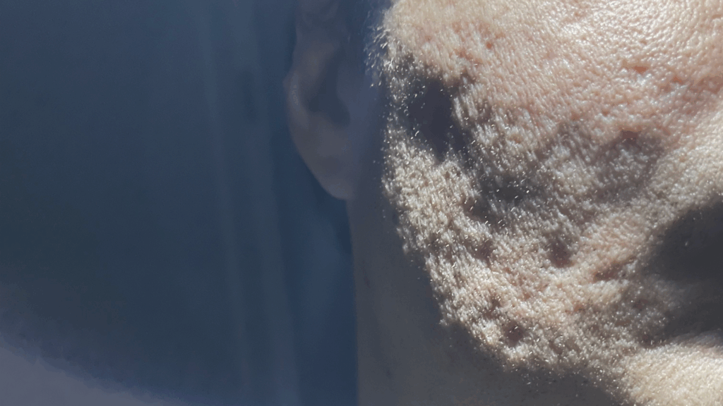 Acne Scar Contact Page (3)