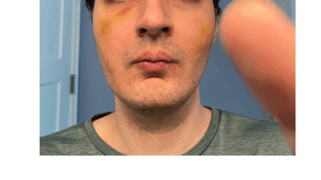 Acne Scar Contact Page (7)