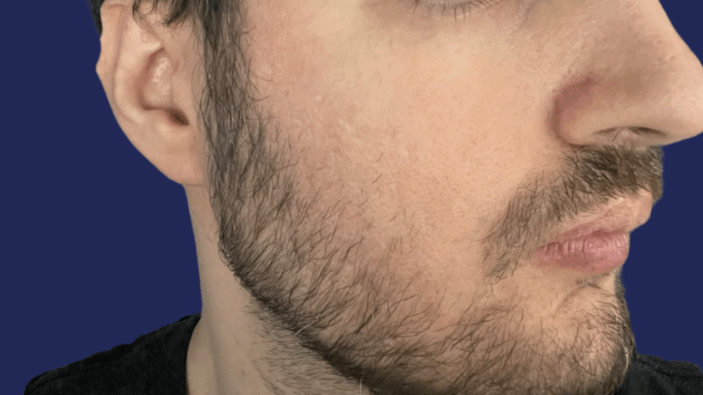 Acne Scar Contact Page (8)