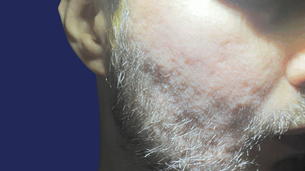 Acne Scar Contact Page (9)