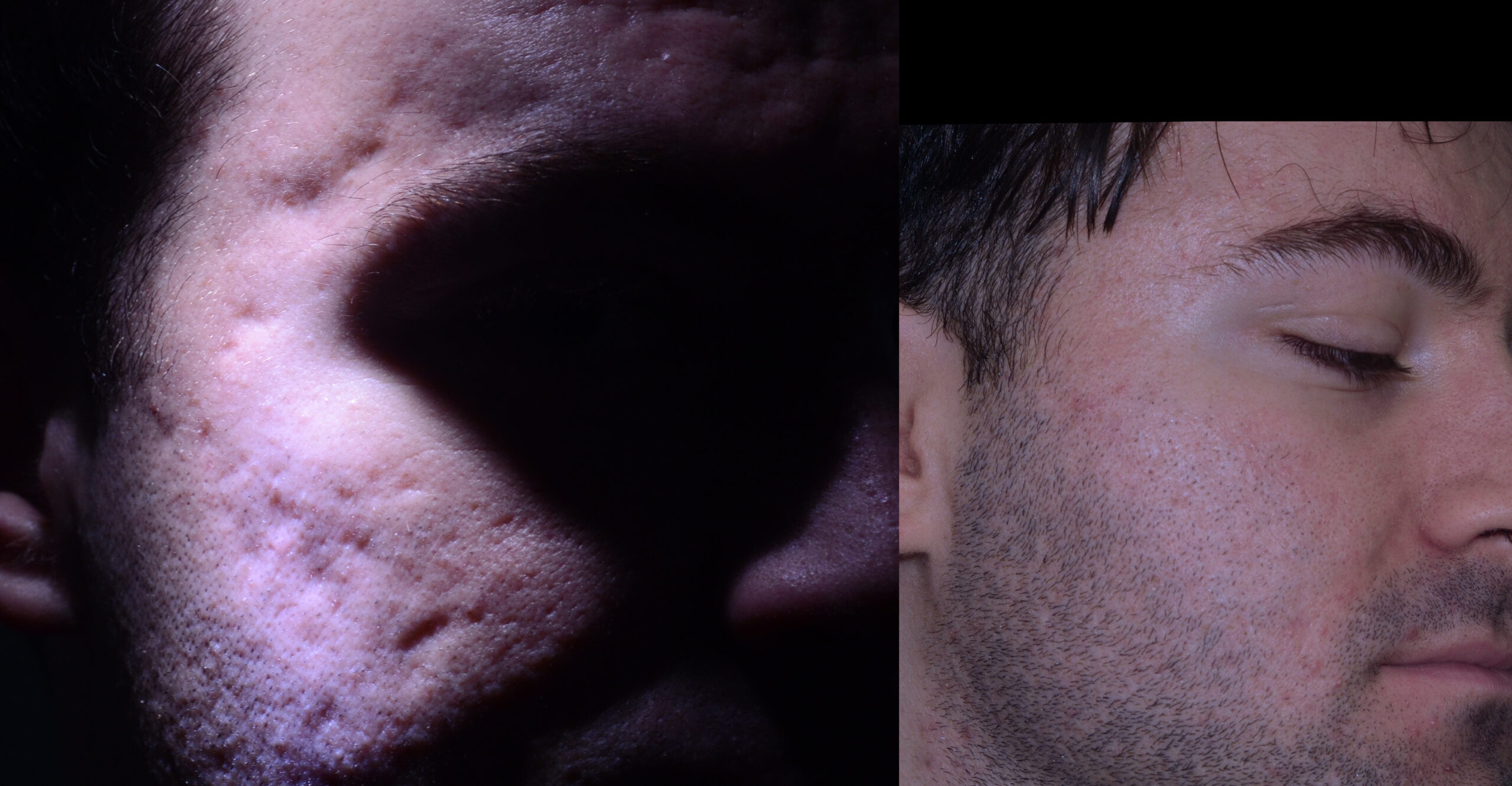 Before and after subcision and fat graft