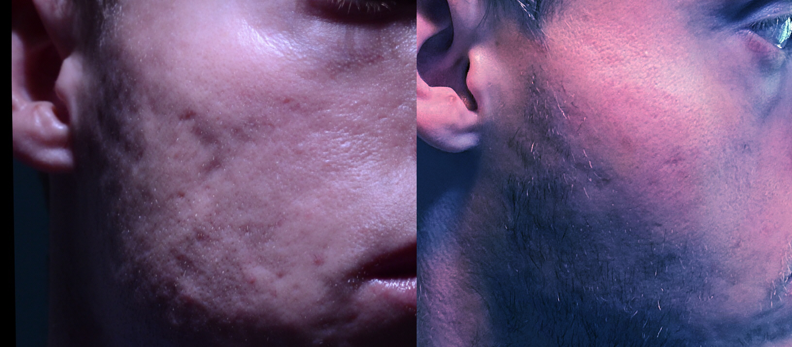 Rewind subcision with fat graft